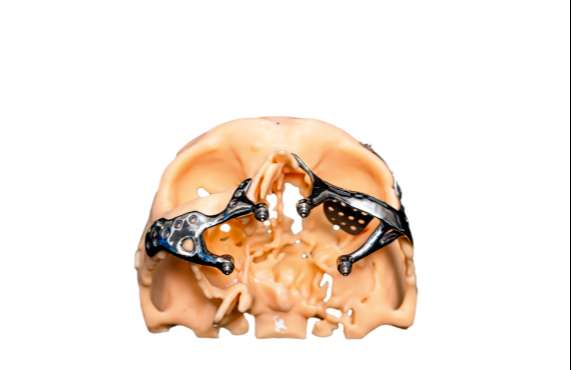 Mucormycosis